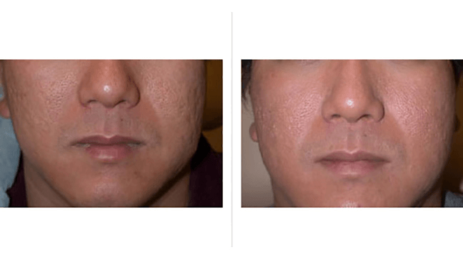 Top 10 Best Expert-Approved Ways To Fade All Types Of Scars 620